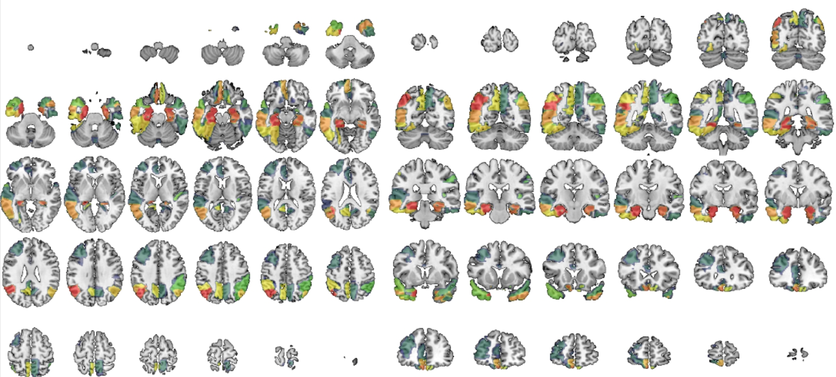 Alzheimer Disease
