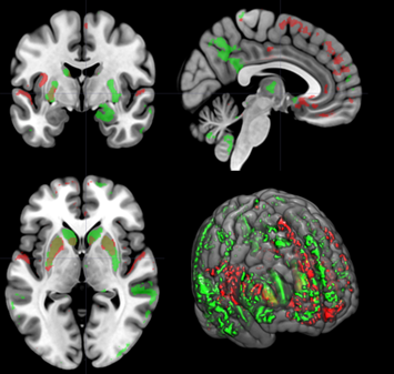 Autism Spectrum Disorder