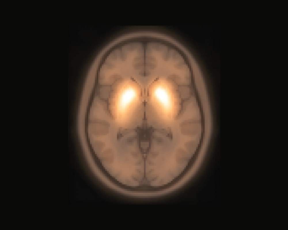 Parkinson’s Disease